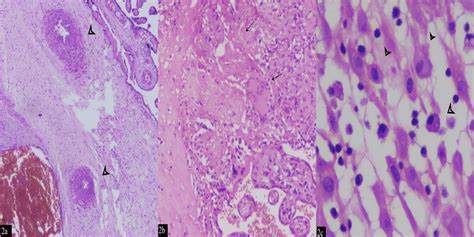 a: Shows chorionic villi with arrow tips at Langhans giant cell with ...