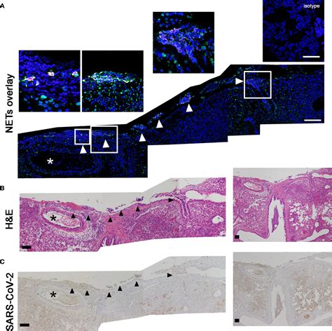 Frontiers Vasculitis And Neutrophil Extracellular Traps In Lungs Of