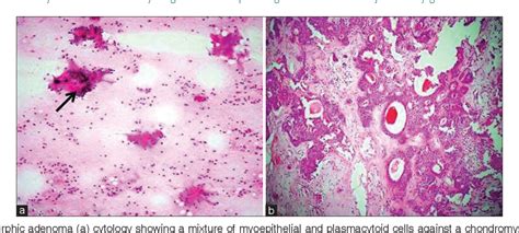 Figure 1 From Role Of Fine Needle Aspiration Cytology In The Diagnosis