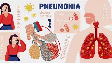 Complications Of Pneumonia நிமோனியாவின் தீவிர சிக்கல் இது தான் Onlymyhealth