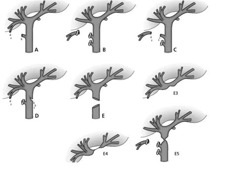 Classification Of Bile Duct Injuries According To Strasberg Et Al