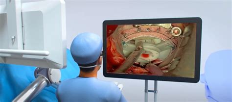 Minimally Invasive Mitral Valve Replacement With A Robotic Digital Microscope Ctsnet