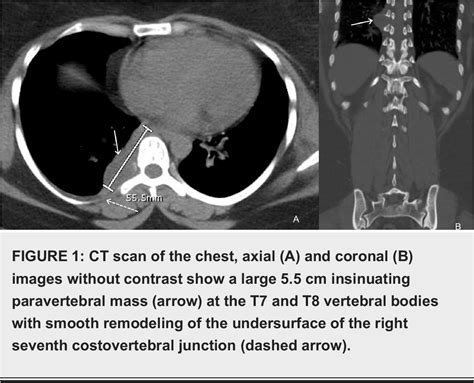 Figure From Spinal Epidural Capillary Hemangioma With Intrathoracic