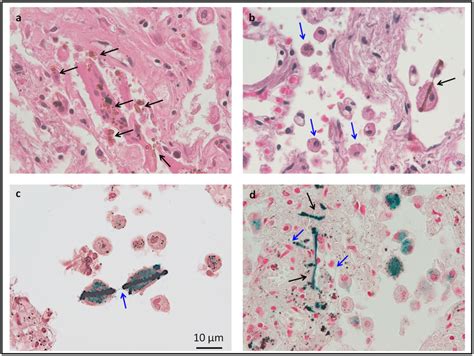 Histological Examination Of Human Lung Tissue With Asbestos Bodies