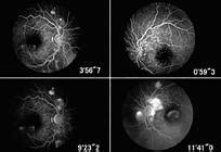 Scielo Brasil Serous Retinal Detachment As An Early Manifestation