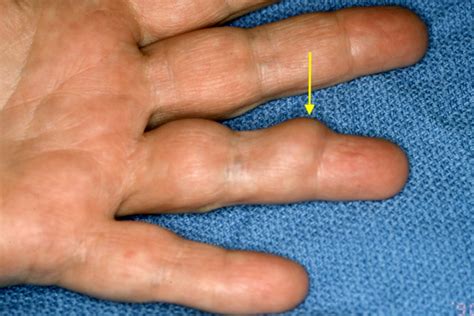 Giant Cell Tumor Of Tendon Sheath Xanthoma Hand Surgery Resource