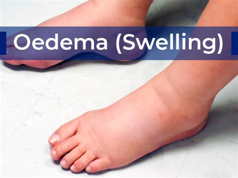 Oedema: Types, Causes, Symptoms, Treatment And Management - Boldsky.com