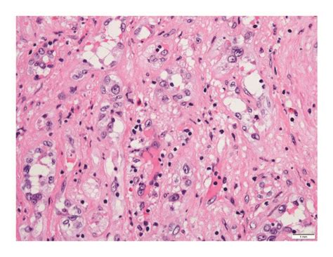 Photomicrographs Of Hepatic Epithelioid Hemangioendothelioma A This