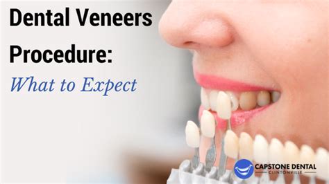 Dental Veneers Procedure - Dental News Network