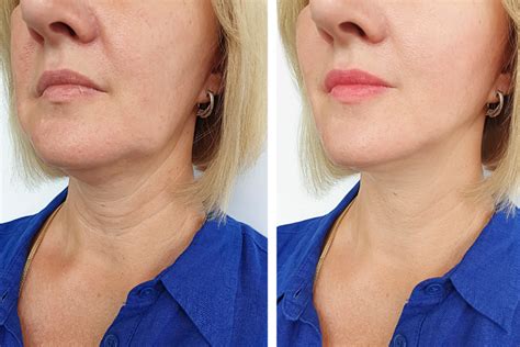 Best Non Surgical Facelift A Honest Ultherapy Full On