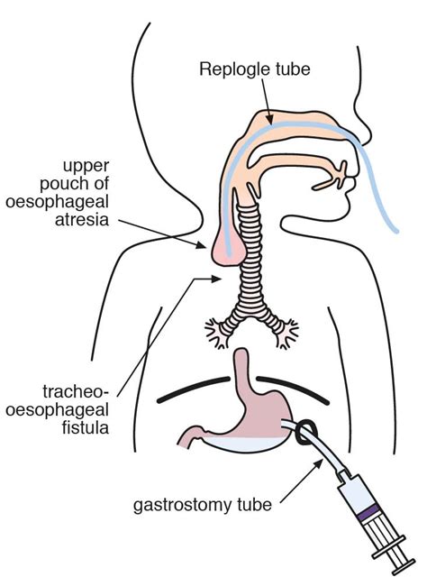 Esophageal Atresia Repair