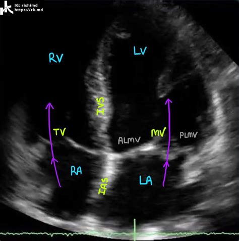 Cardiac Transthoracic Echocardiography (TTE) - Summary And Labeled ...