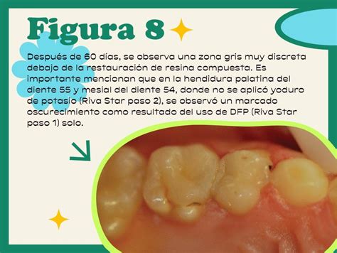 Fluoruro De Plata Diamino Restauraci N Dental Hay Una Justificaci N