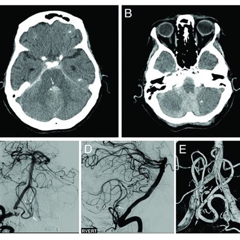 Preoperative Computed Tomography Ct And Angiogram A B Note The