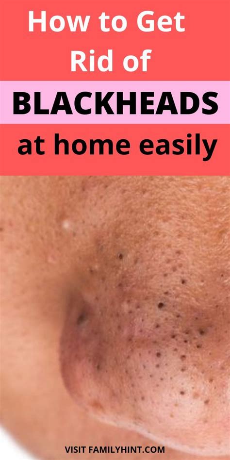 Pin On Blackheads Removal