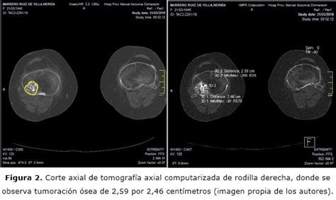 Encondroma A Propósito De Un Caso Alvarez López Archivo Médico Camagüey