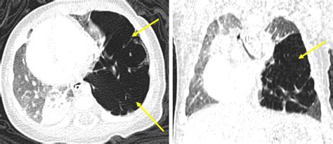 Congenital Lobar Hyperinflation Radiology Cases