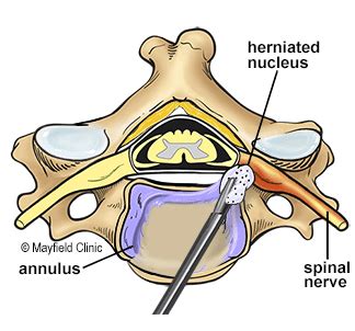 Cervical Disc Replacement – Meet Dr. Joel Edionwe