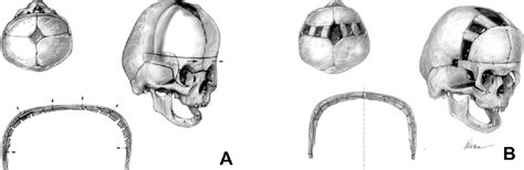 Figure 1 From The Craniofacial Dysostosis Syndromes Current Surgical