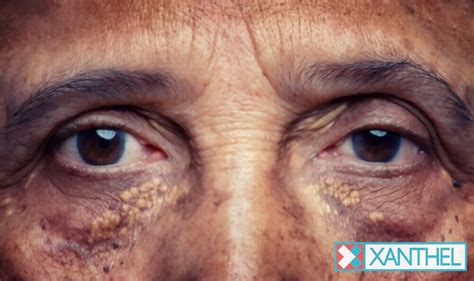 Eyelid Xanthomas Xanthelasma Treatment