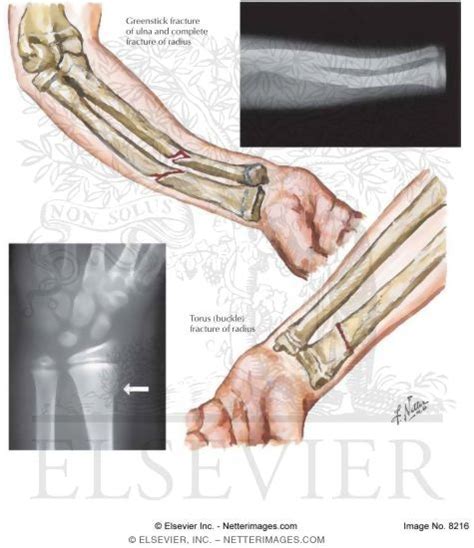 Greenstick And Torus Fractures In Children