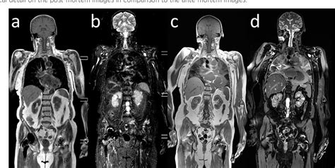 Figure 1 From Essentials Of Forensic Post Mortem MR Imaging In Adults