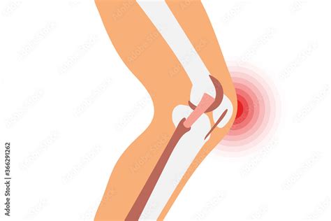 joint pain illustration bone pain ache arthritis orthopedic medical