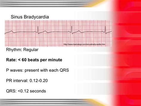 Bradycardia Ekg Vs Normal Sinus Rhythm