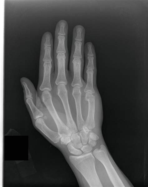 CasesBlog - Medical and Health Blog: Boxer's Fracture