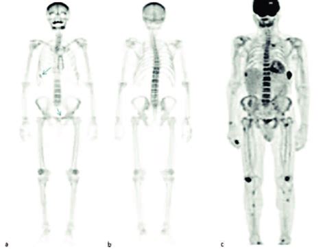 Anterior A And Posterior B View Of The M Tc Mdp Bone Scans