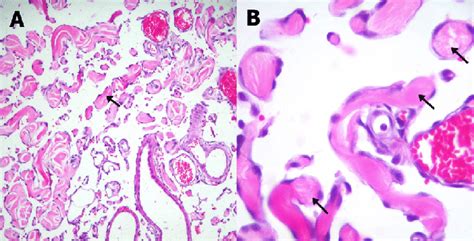 Photomicrograph of the lymphangiossarcoma describe in this report ...