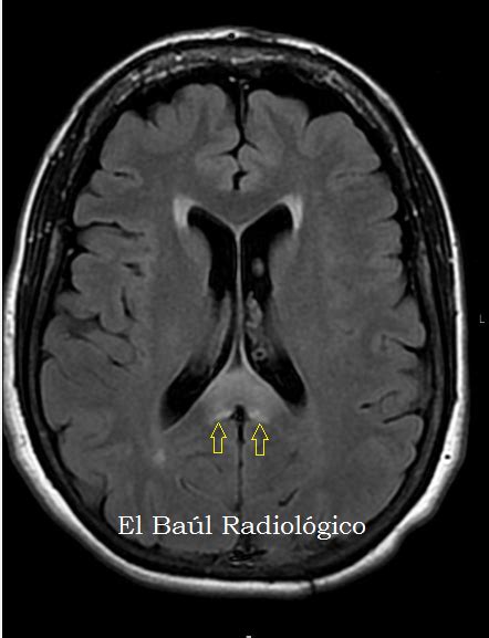 El Ba L Radiol Gico Afectaci N Patol Gica Del Cuerpo Calloso Some