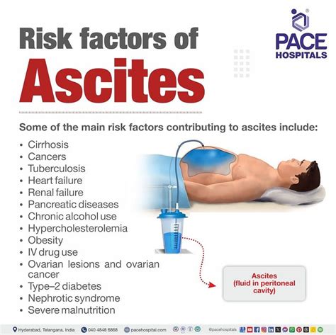 Ascites - Symptoms, Causes, Complications, Prevention, Treatment