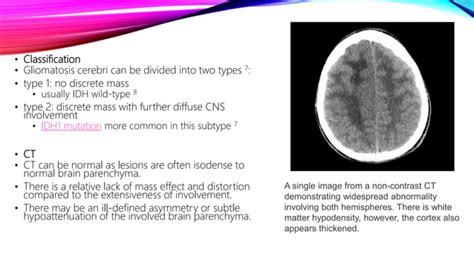 Basic And Advanced Imaging In Adult Gliomas PPT