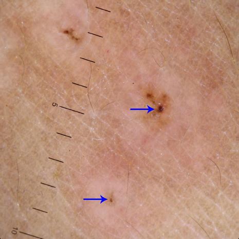 Erythema Multiforme Like Reaction Following Covid Vaccination