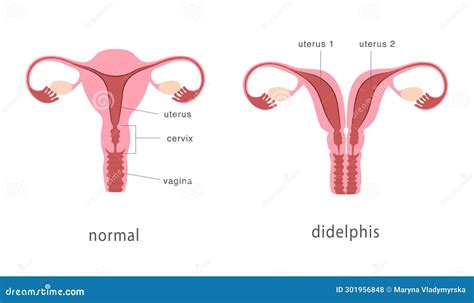 Uterine Septum Septate Uterus Female Reproductive System Front View