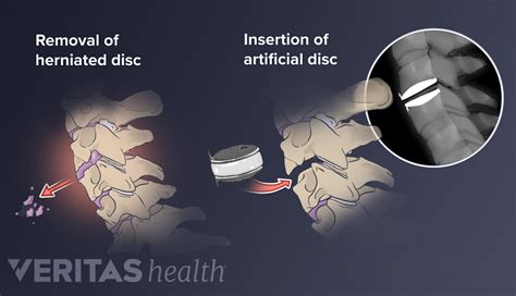 Cervical Artificial Disc Replacement Surgery Spine Health