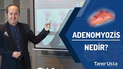 Adenomyozis Nedir Prof Dr Taner Usta Youtube