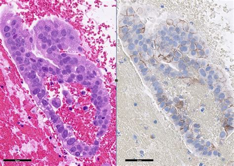 Pathology Outlines Adenocarcinoma Overview