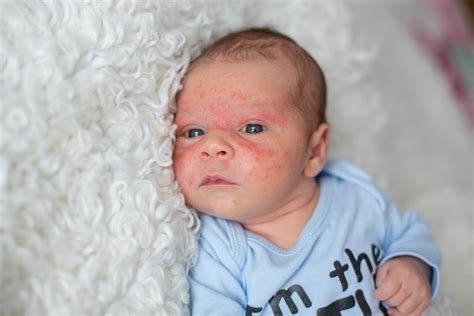 Food Allergic Reaction v. Eczema Flare-Up: Which One Is My Child Having ...