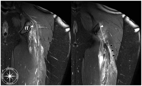 Pulled Hamstring Mri