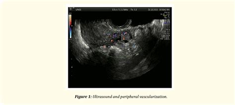 Figure 1 From The Role Of Laparoscopy In The Diagnosis And Treatment Of Ectopic Pregnancy In