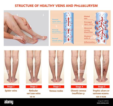 Thrombophlebitis Leg