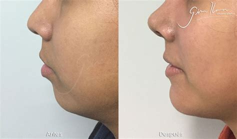 Aumento De Ment N Dr Gino Llosa Endoscopic Deep Plane Facelift