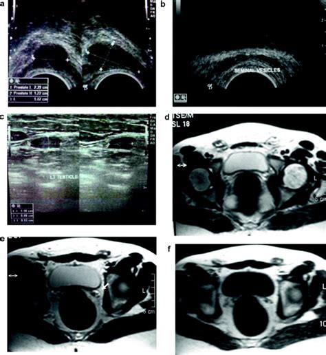 Does Mri Add To Ultrasound In The Assessment Of Disorders Of Sex