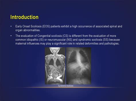 Evaluation Of Patients With Early Onset Scoliosis Ppt Download