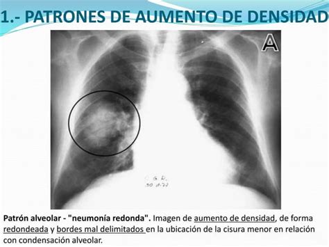 Principales Patrones Radiológicos En La Placa Simple De Tórax Ppt