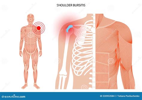 Shoulder Bursitis Inflamed Bursa And Supraspinatus Tendon Stock Image