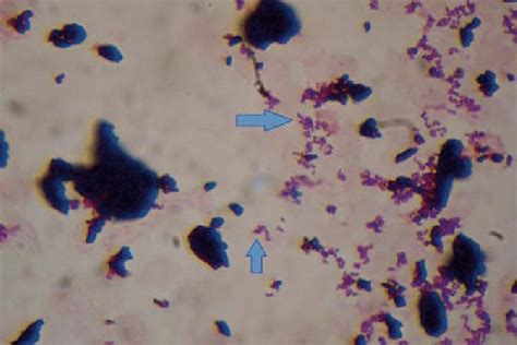 Gram-stain preparation of the positive blood culture examined with 100x ...