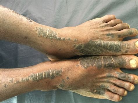 Full Article Necrolytic Acral Erythema Current Insights